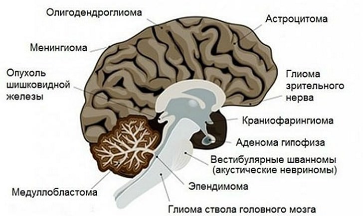 Первичные опухоли головного мозга 