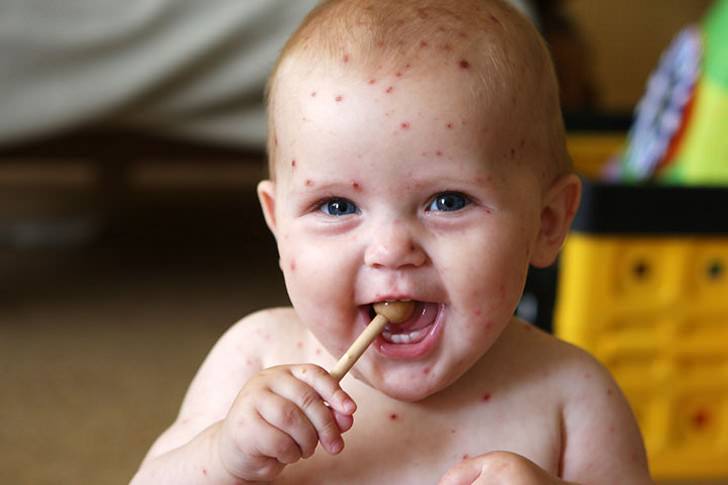 Лимфопения часто сопровождает заболевание ребенка ветряной оспой или иных кожных поражений 