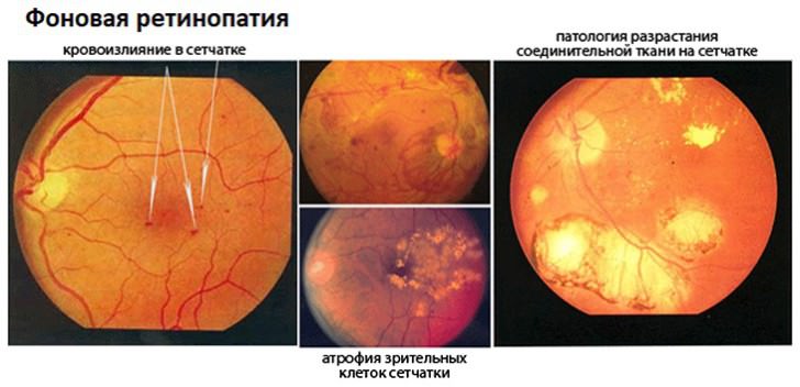 Фоновая ретинопатия