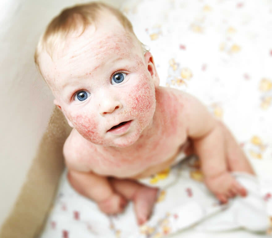 атопічний дерматит у немовляти