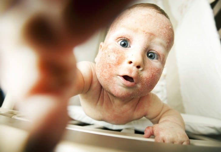 Атопічний дерматит у немовлят thumbnail