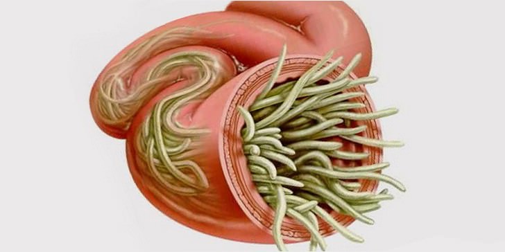 Аскариды в кишечнике: скопления гельминтов приводит к механической кишечной непроходимости