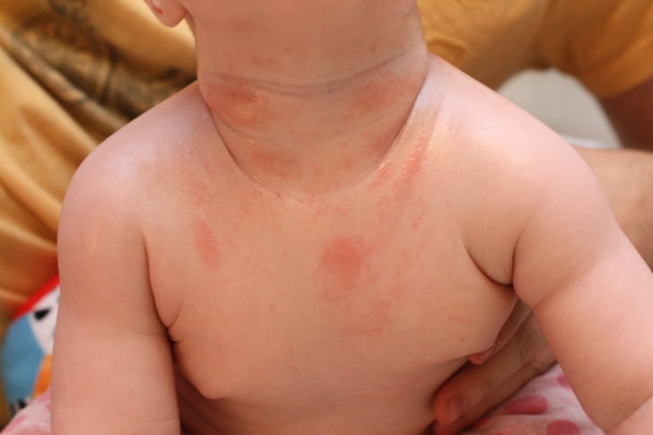 Покраснения и высыпания на коже ребенка имеют свою природу происхождения, которую обязательно необходимо выяснить с лечащим врачом 